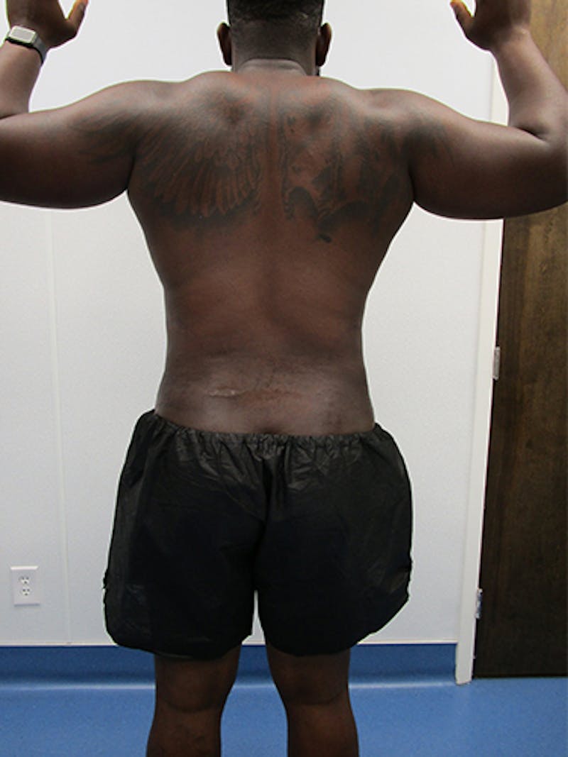 Liposuction Before & After Gallery - Patient 379664 - Image 8