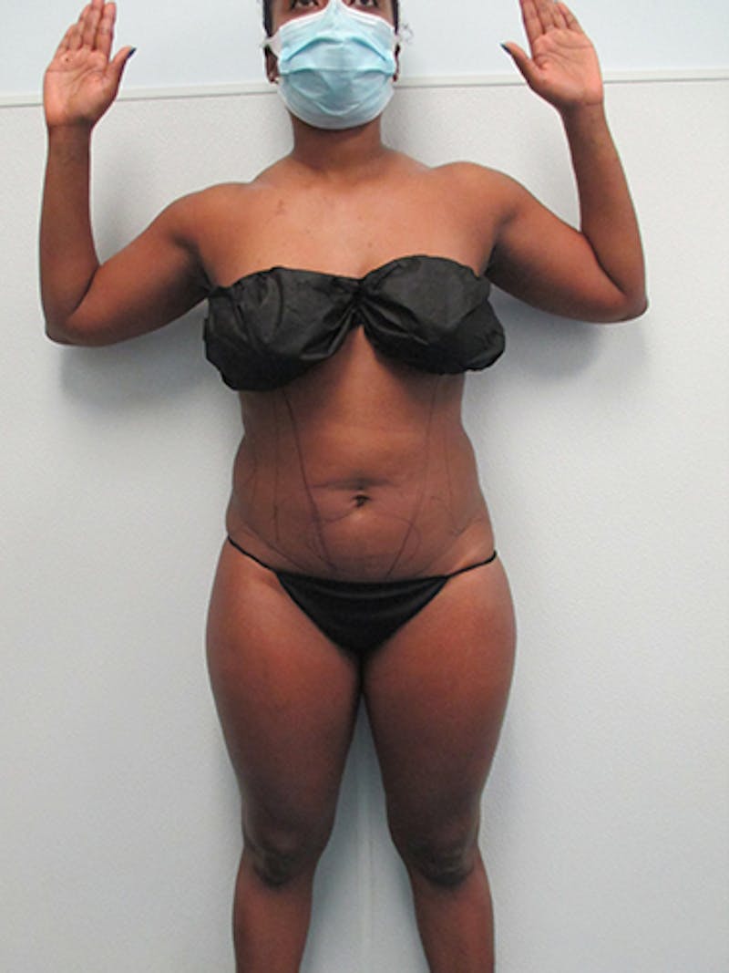 Liposuction Before & After Gallery - Patient 215972 - Image 1