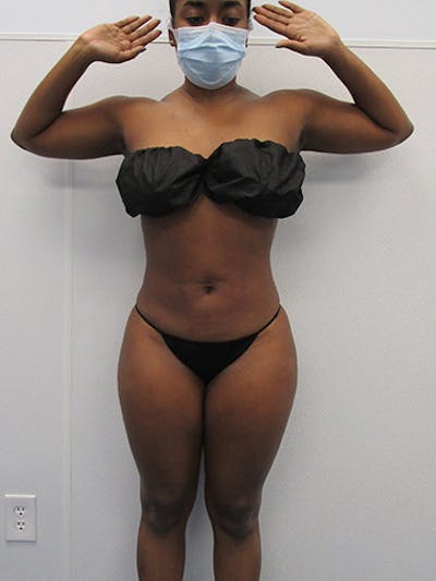 Liposuction Before & After Gallery - Patient 215972 - Image 2