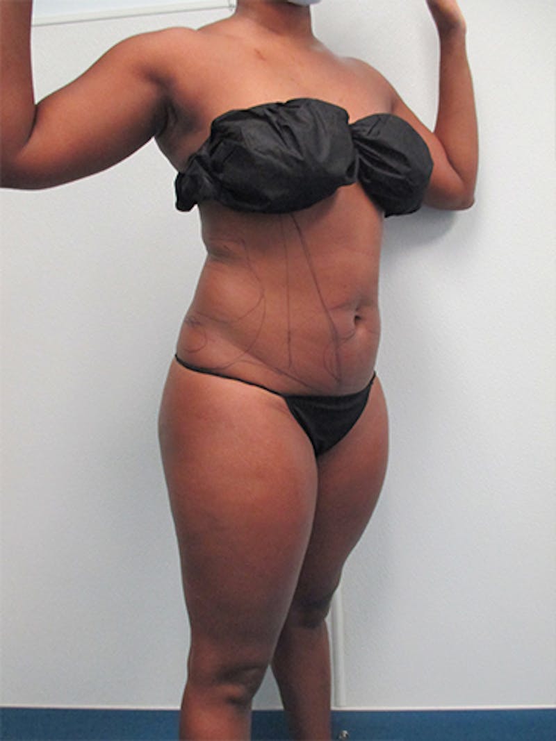 Liposuction Before & After Gallery - Patient 215972 - Image 5