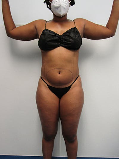 Liposuction Before & After Gallery - Patient 259777 - Image 1