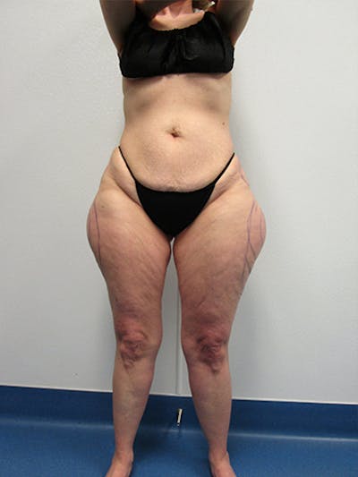 Liposuction Before & After Gallery - Patient 283409 - Image 1