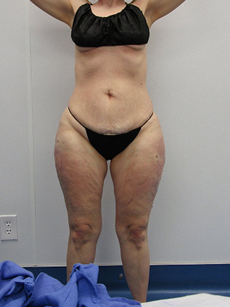 Liposuction Before & After Gallery - Patient 283409 - Image 2