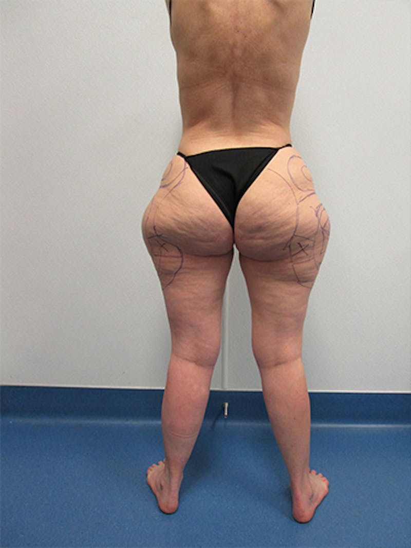 Liposuction Before & After Gallery - Patient 283409 - Image 3