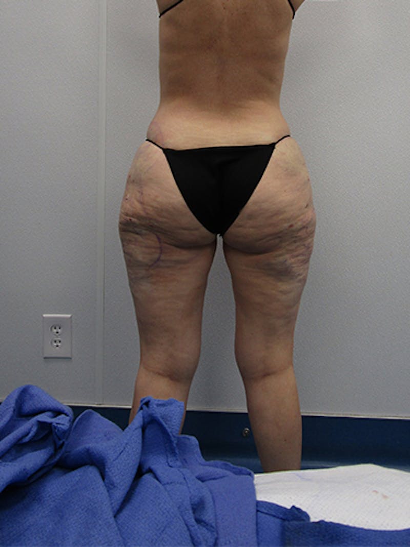 Liposuction Before & After Gallery - Patient 283409 - Image 4