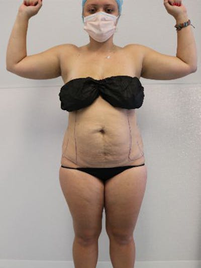 Liposuction Before & After Gallery - Patient 879657 - Image 1