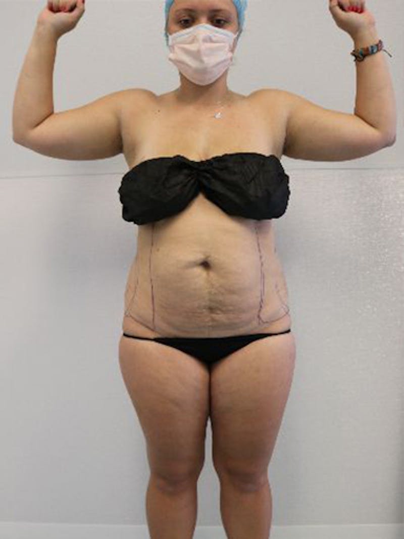 Silhouette Liposuction Before & After Gallery - Patient 328939 - Image 1