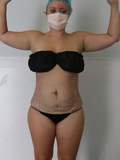 Liposuction Before & After Gallery - Patient 879657 - Image 2
