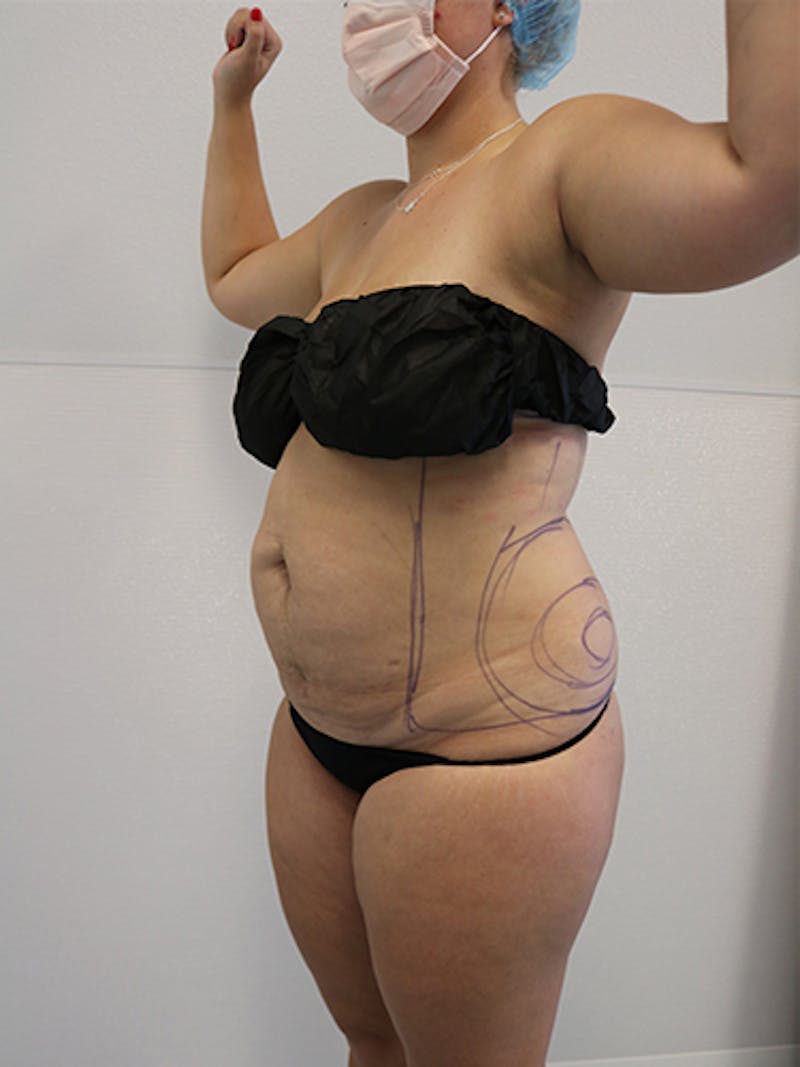 Silhouette Liposuction Before & After Gallery - Patient 328939 - Image 3