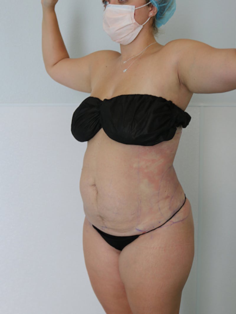 Silhouette Liposuction Before & After Gallery - Patient 328939 - Image 4