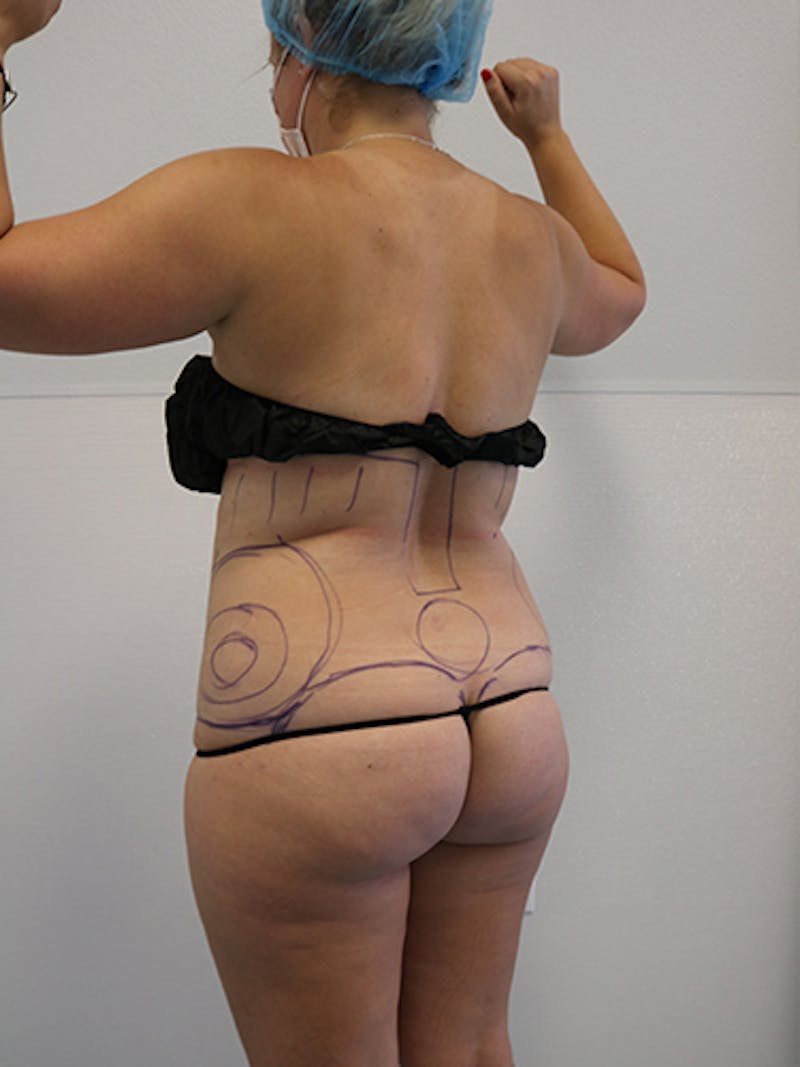 Silhouette Liposuction Before & After Gallery - Patient 328939 - Image 5