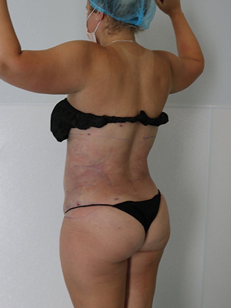 Silhouette Liposuction Before & After Gallery - Patient 328939 - Image 6