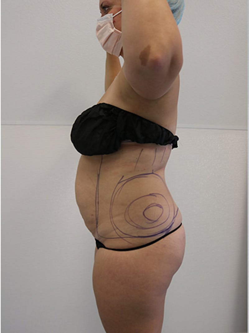 Silhouette Liposuction Before & After Gallery - Patient 328939 - Image 7