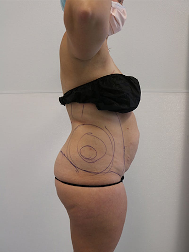 Silhouette Liposuction Before & After Gallery - Patient 328939 - Image 9