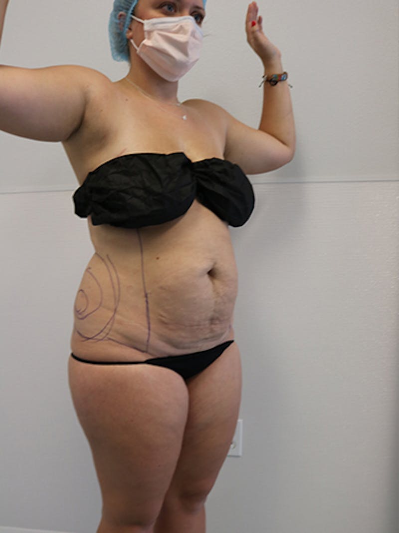 Silhouette Liposuction Before & After Gallery - Patient 328939 - Image 11