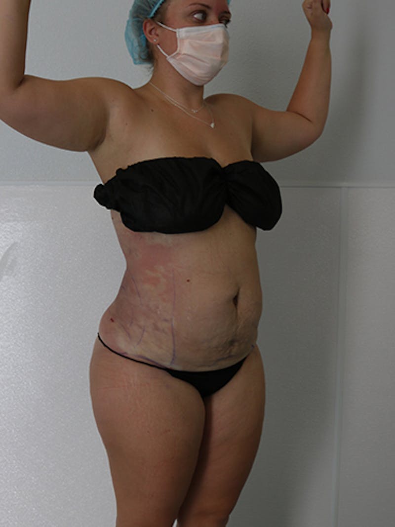 Silhouette Liposuction Before & After Gallery - Patient 328939 - Image 12