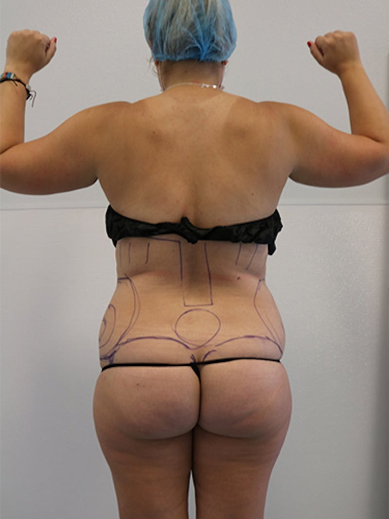 Silhouette Liposuction Before & After Gallery - Patient 328939 - Image 15