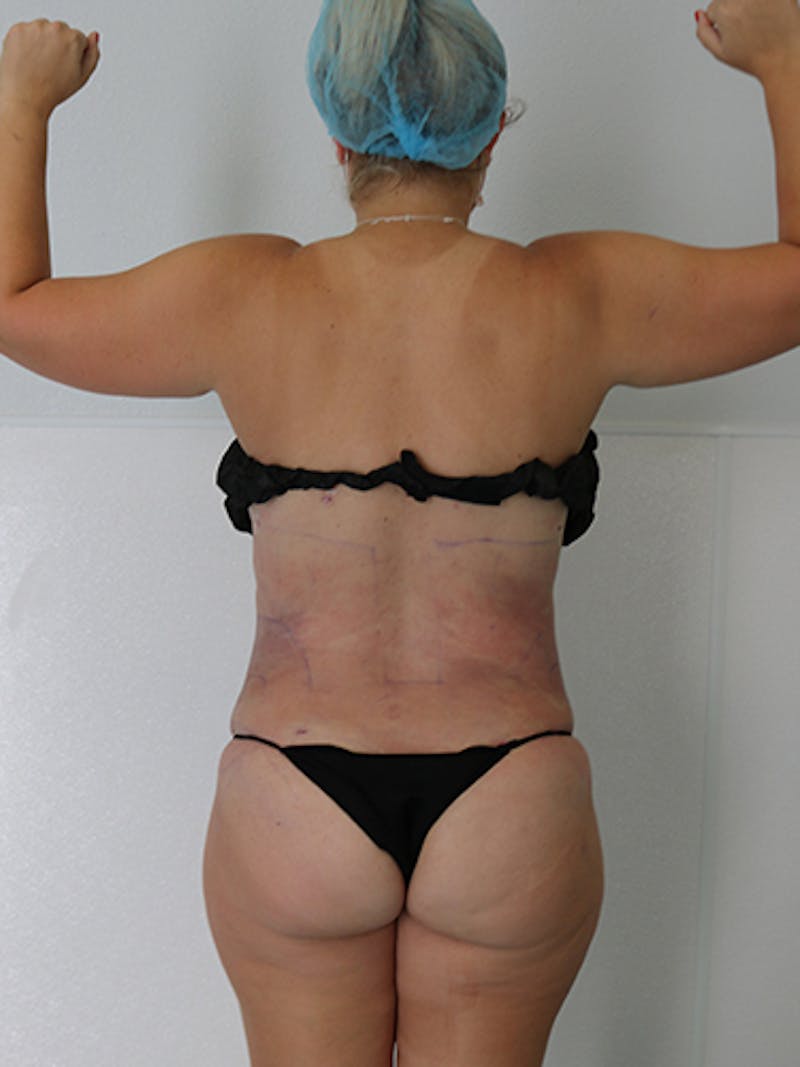 Silhouette Liposuction Before & After Gallery - Patient 328939 - Image 16
