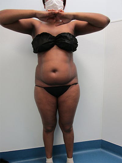 Liposuction Before & After Gallery - Patient 360176 - Image 1