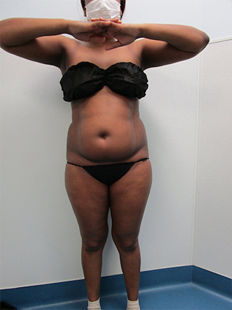Liposuction Before & After Gallery - Patient 360176 - Image 1