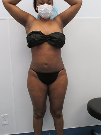 Liposuction Before & After Gallery - Patient 360176 - Image 2