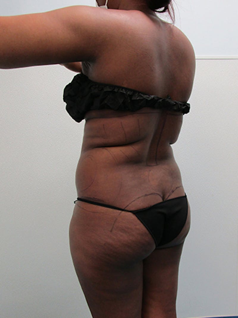 Liposuction Before & After Gallery - Patient 360176 - Image 3