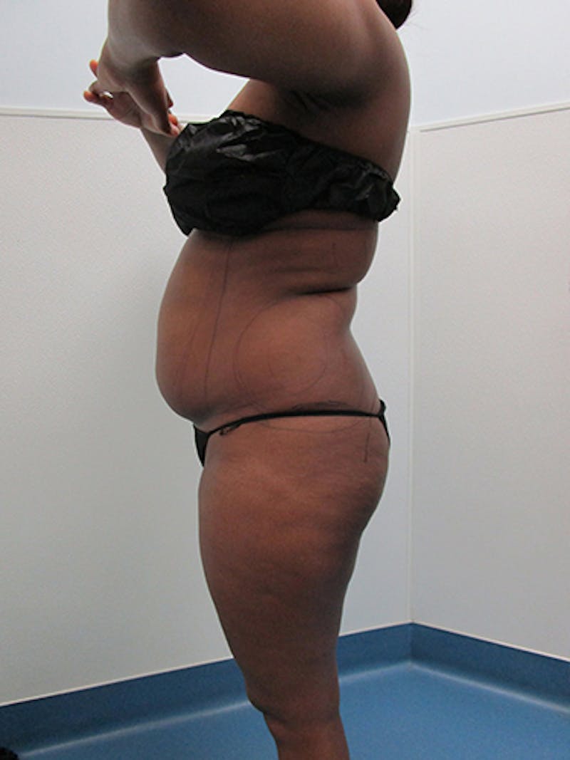 Liposuction Before & After Gallery - Patient 360176 - Image 5