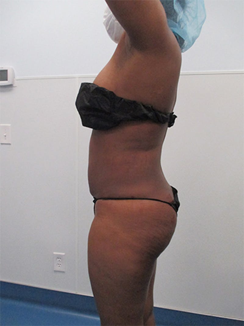 Liposuction Before & After Gallery - Patient 360176 - Image 6