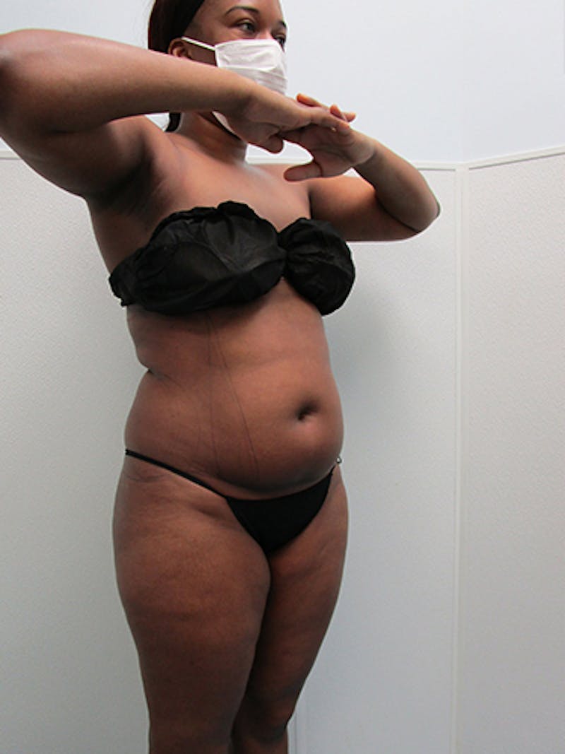 Liposuction Before & After Gallery - Patient 360176 - Image 7