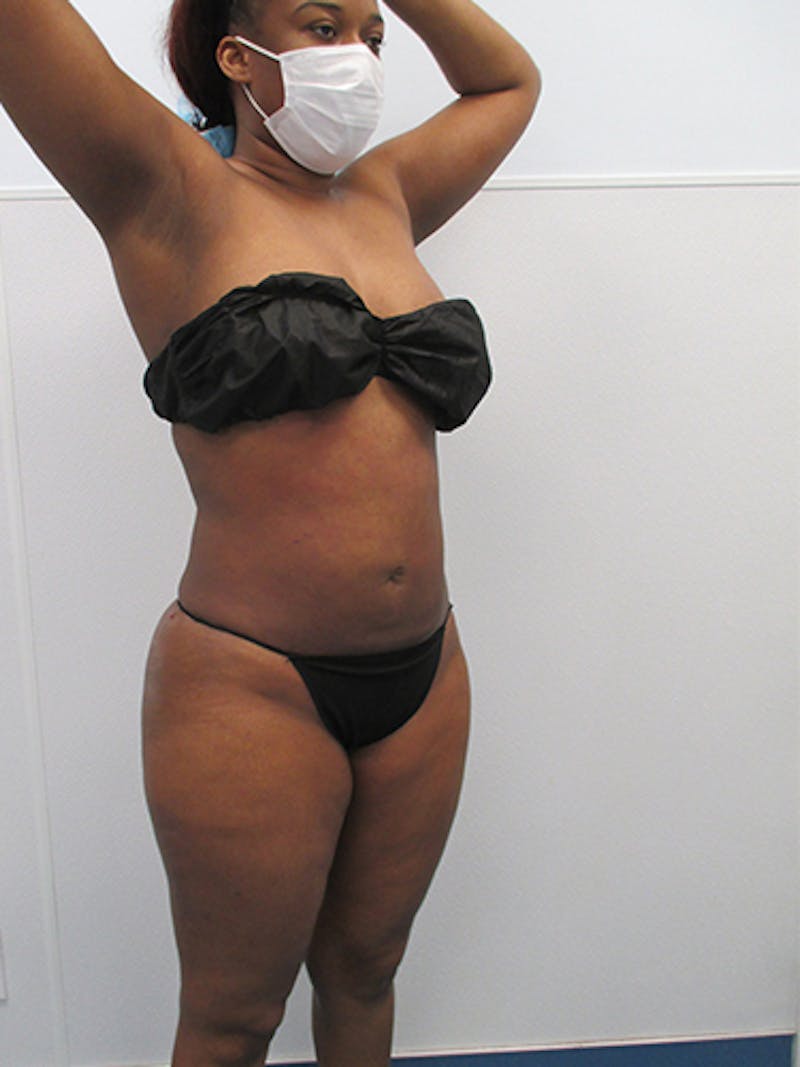 Liposuction Before & After Gallery - Patient 360176 - Image 8