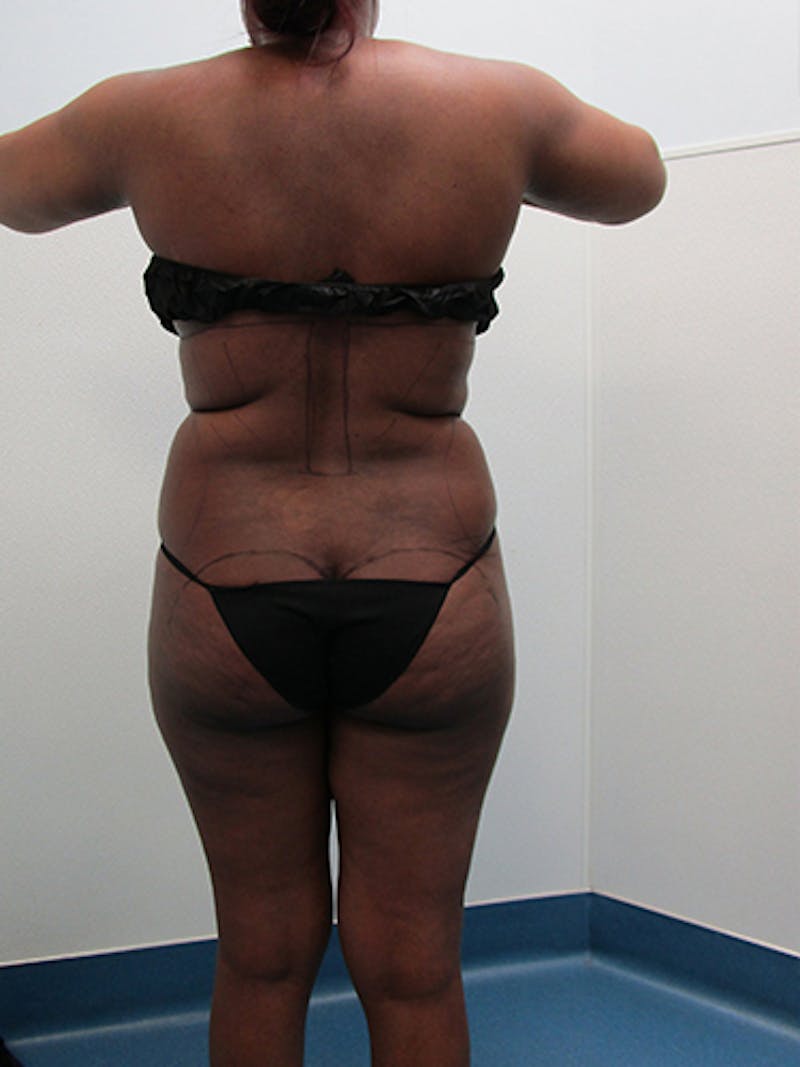 Liposuction Before & After Gallery - Patient 360176 - Image 9