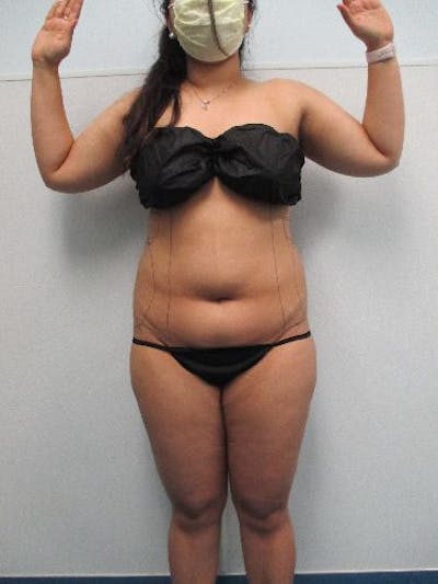 Liposuction Before & After Gallery - Patient 240439 - Image 1