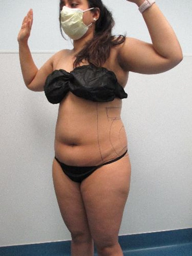 Liposuction Before & After Gallery - Patient 240439 - Image 3
