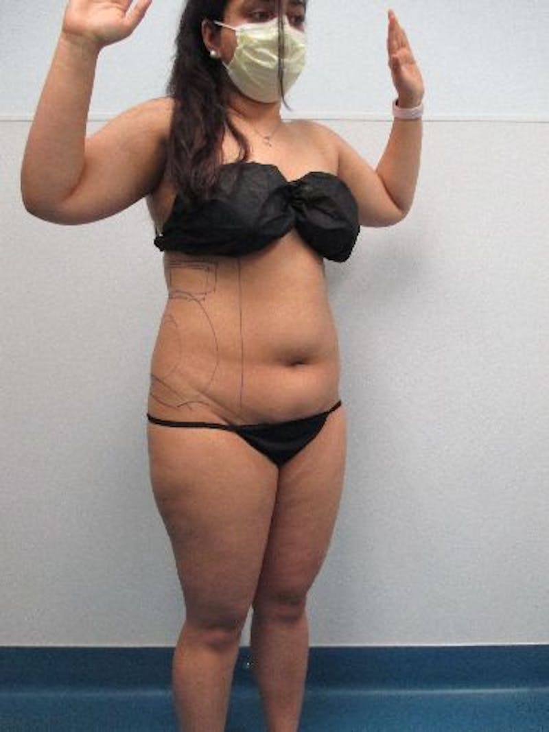 Liposuction Before & After Gallery - Patient 240439 - Image 5