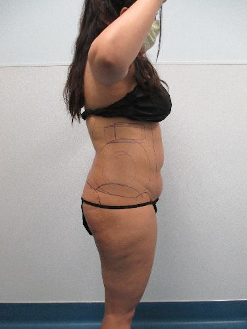 Liposuction Before & After Gallery - Patient 240439 - Image 7