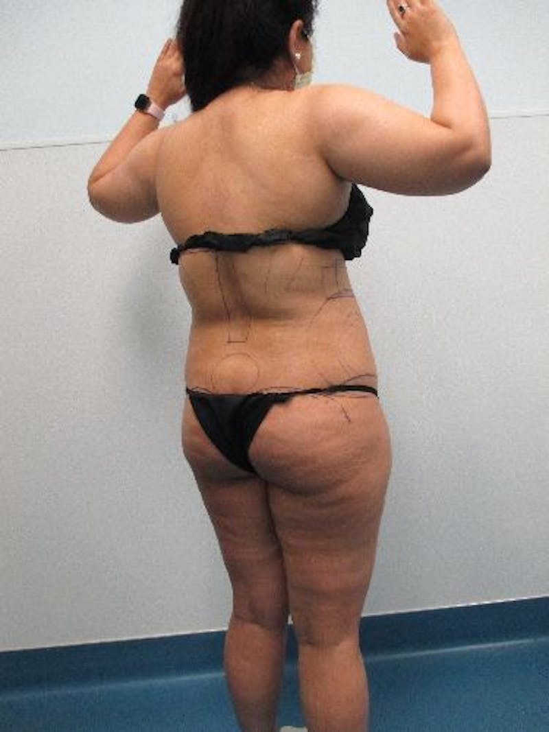 Liposuction Before & After Gallery - Patient 240439 - Image 9