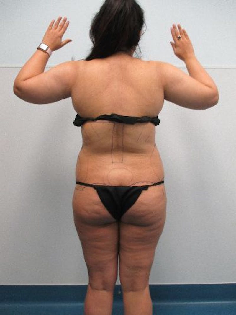 Liposuction Before & After Gallery - Patient 240439 - Image 11