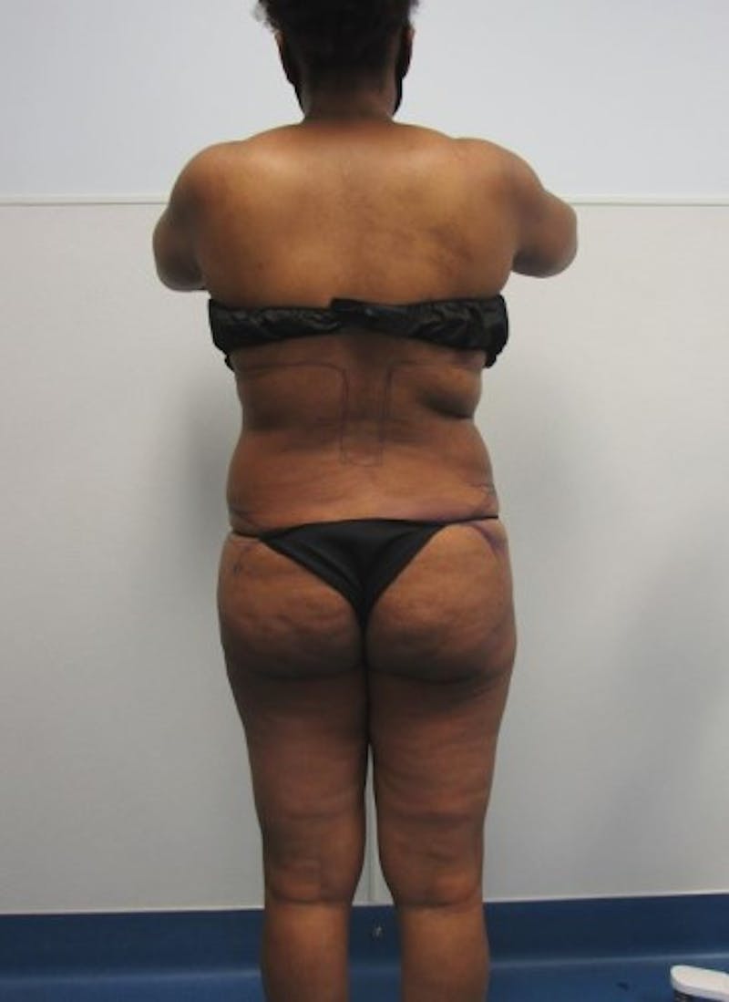 Liposuction Before & After Gallery - Patient 291970 - Image 1
