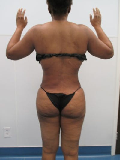 Liposuction Before & After Gallery - Patient 291970 - Image 2