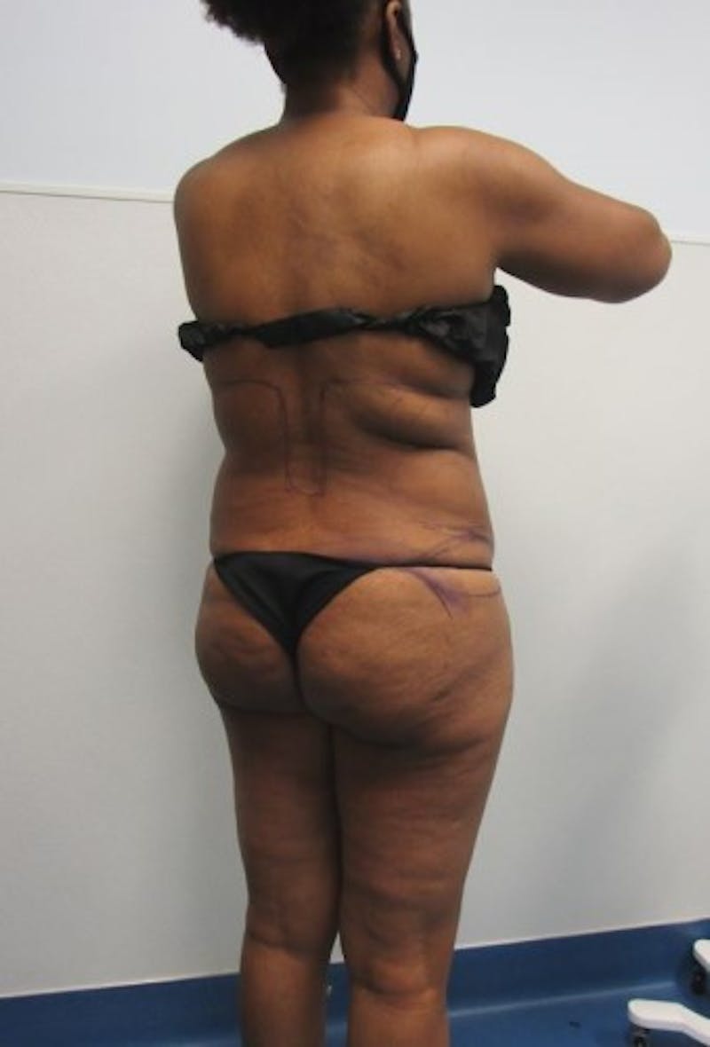 Liposuction Before & After Gallery - Patient 291970 - Image 3