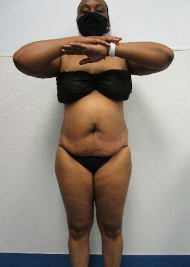 Liposuction Before & After Gallery - Patient 291970 - Image 5