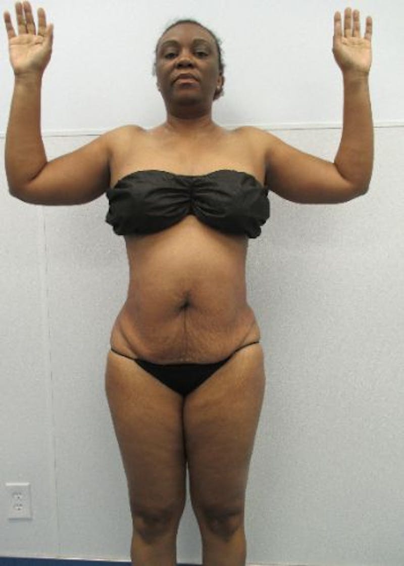 Liposuction Before & After Gallery - Patient 291970 - Image 6