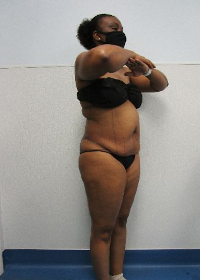 Liposuction Before & After Gallery - Patient 291970 - Image 7