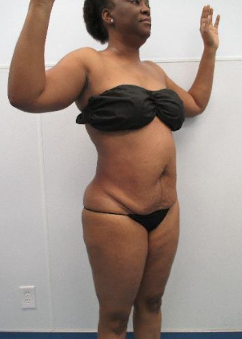 Liposuction Before & After Gallery - Patient 291970 - Image 8