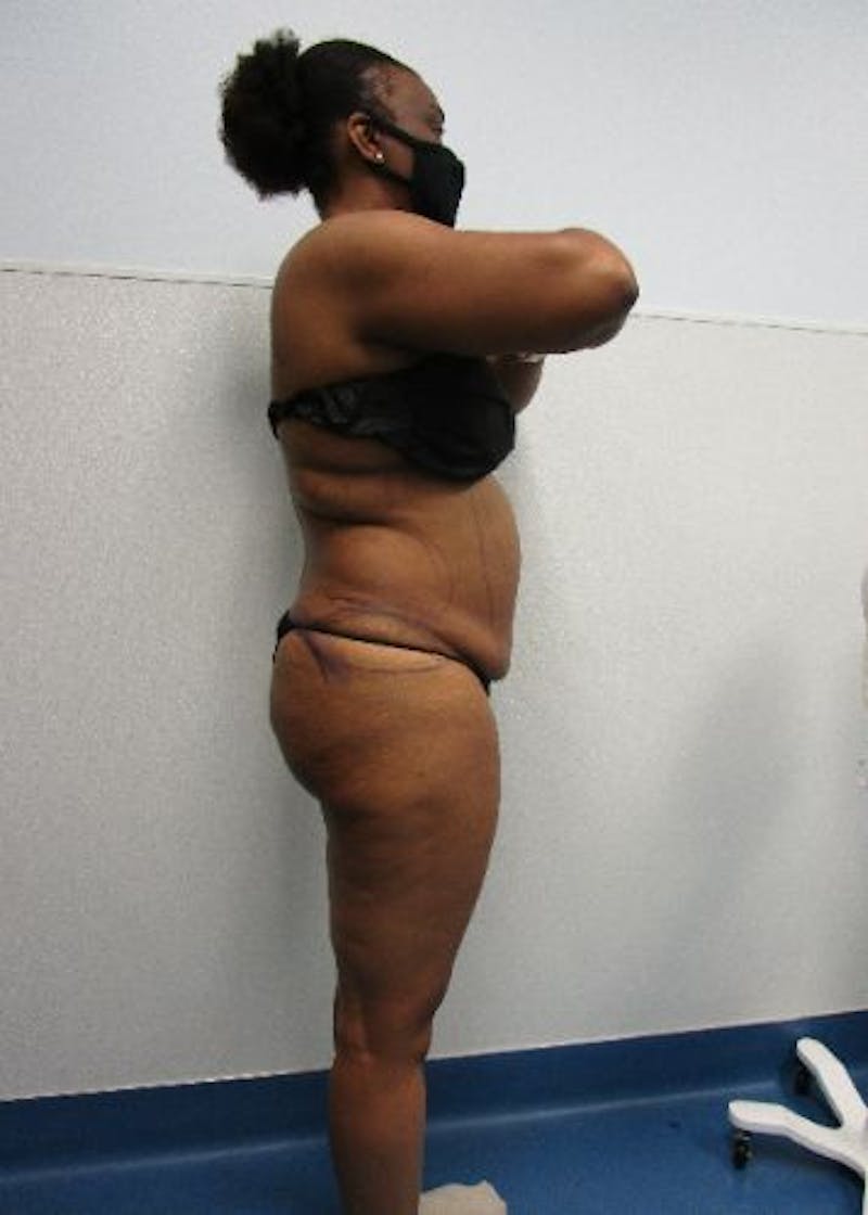 Liposuction Before & After Gallery - Patient 291970 - Image 9