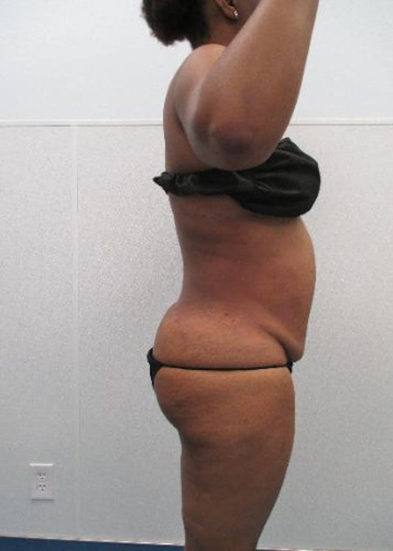Liposuction Before & After Gallery - Patient 291970 - Image 10