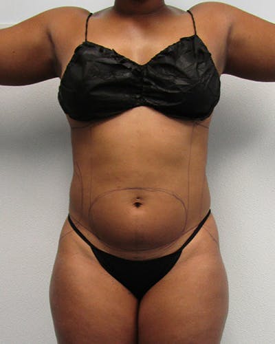 Liposuction Before & After Gallery - Patient 676946 - Image 1