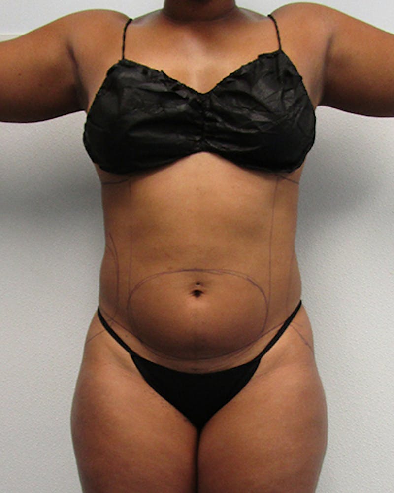 Liposuction Before & After Gallery - Patient 676946 - Image 1