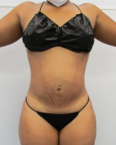 Liposuction Before & After Gallery - Patient 676946 - Image 2