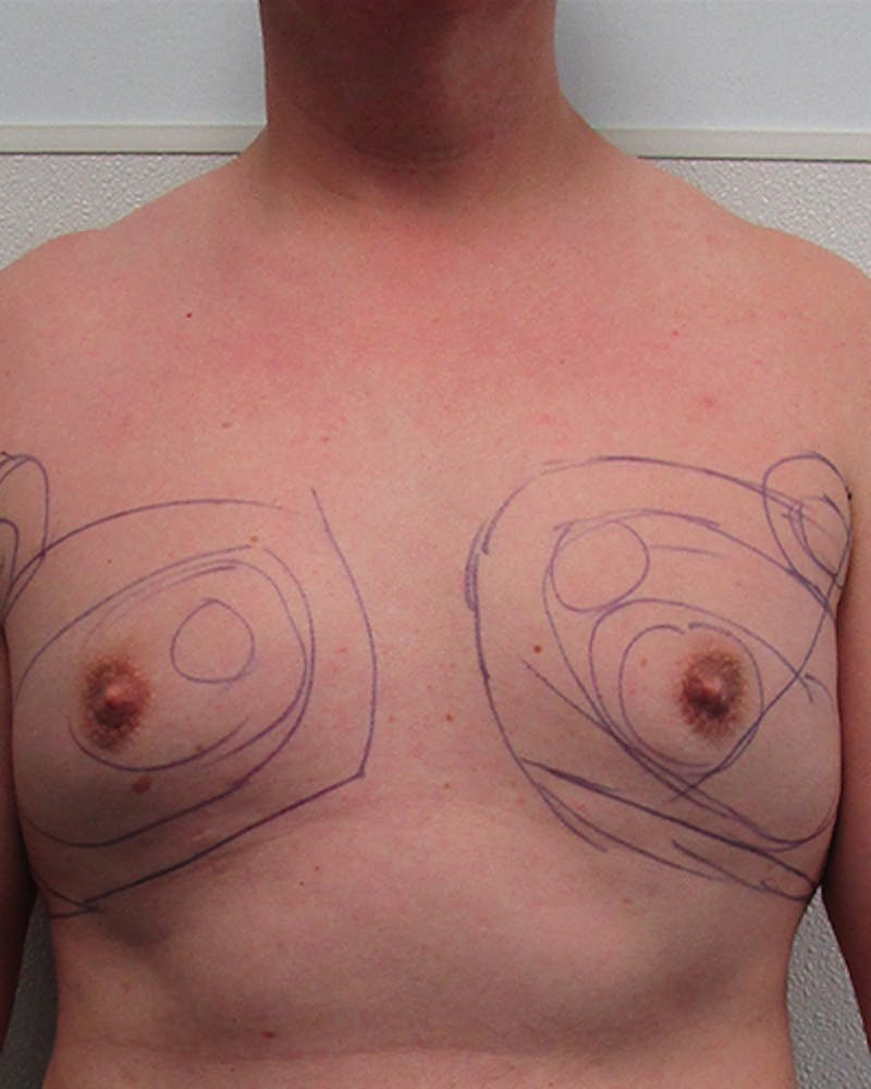 Liposuction Before & After Gallery - Patient 178098 - Image 1